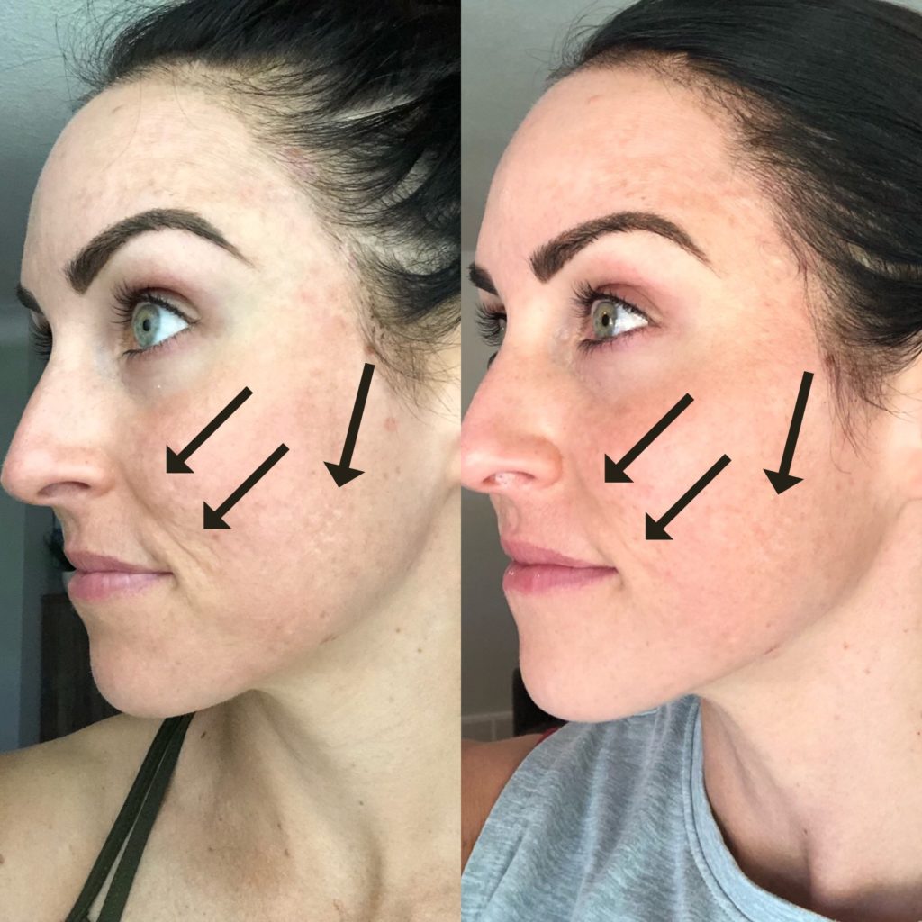 How Long Does It Take to See Results From Micro Needling?