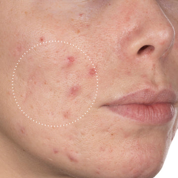 Niacinamide Peptides before, day 0